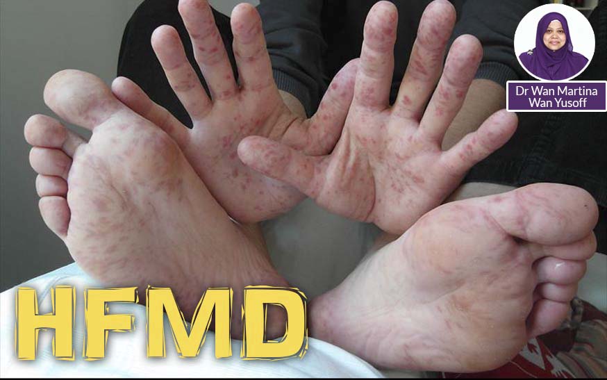 Panduan Menghadapi Virus HFMD